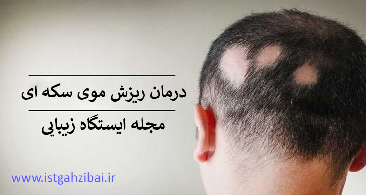 درمان ریزش موی سکه ای سر و صورت